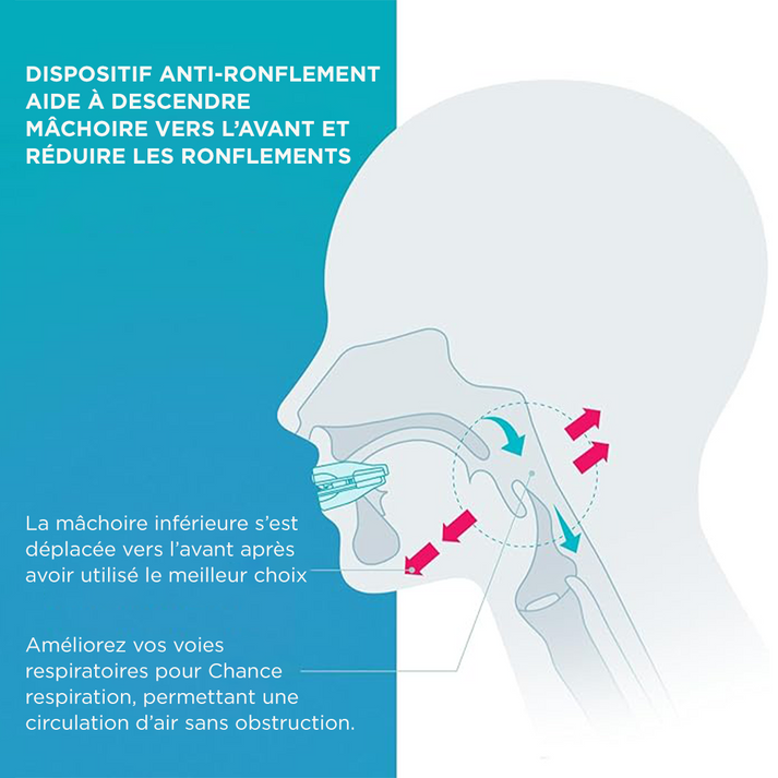 Elastyczna i dopasowująca się orteza przeciw chrapaniu i bezdechowi sennemu