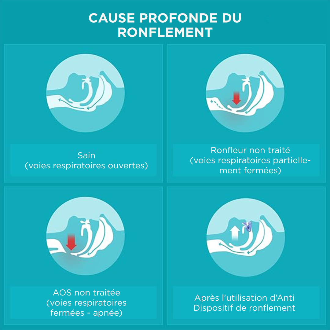 Elastyczna i dopasowująca się orteza przeciw chrapaniu i bezdechowi sennemu